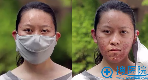 李璐术前照片 李璐术前照片