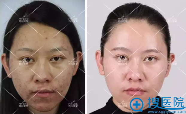 术前与现在对比 术前与现在对比