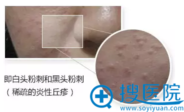 白头粉刺 白头粉刺