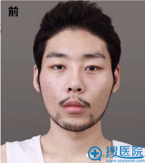 韩国原辰整形医院真人案例 隆鼻+面部轮廓手术让他变身超级帅哥