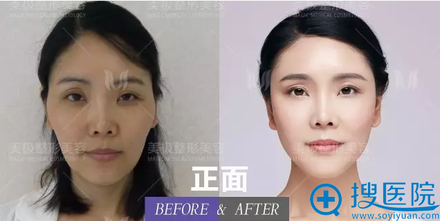 手术前后效果对比图 手术前后效果对比图