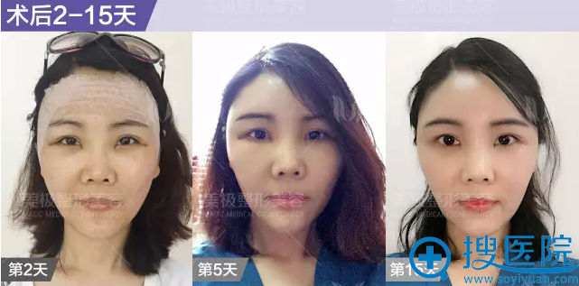 术后2~15天 术后2~15天