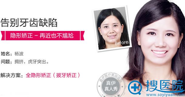 矫正牙齿案例 矫正牙齿案例