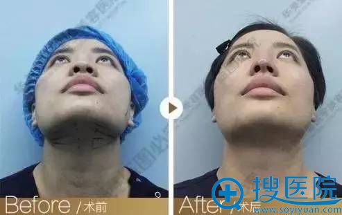 线雕隆鼻即刻效果 线雕隆鼻即刻效果