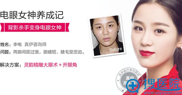 双眼皮整形案例 双眼皮整形案例