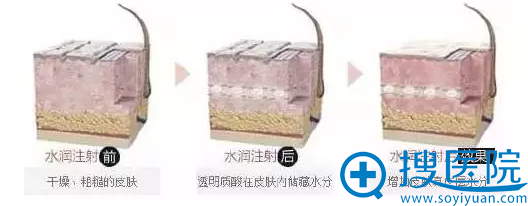 注射前后皮肤状态对比 注射前后皮肤状态对比
