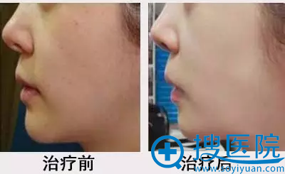 治疗前后对比案例 治疗前后对比案例