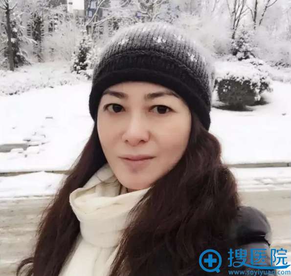 第1次热拉提治疗后一个月照片 第1次热拉提治疗后一个月照片