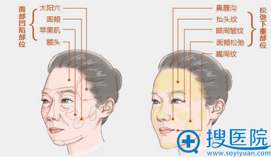 自体脂肪面部各部位填充价格一览表