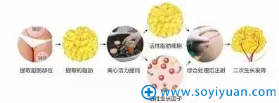 自体脂肪移植过程 自体脂肪移植过程