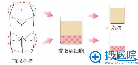 脂肪活化提纯 脂肪活化提纯