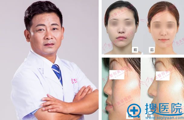 王金州教授隆鼻案例 王金州教授隆鼻案例