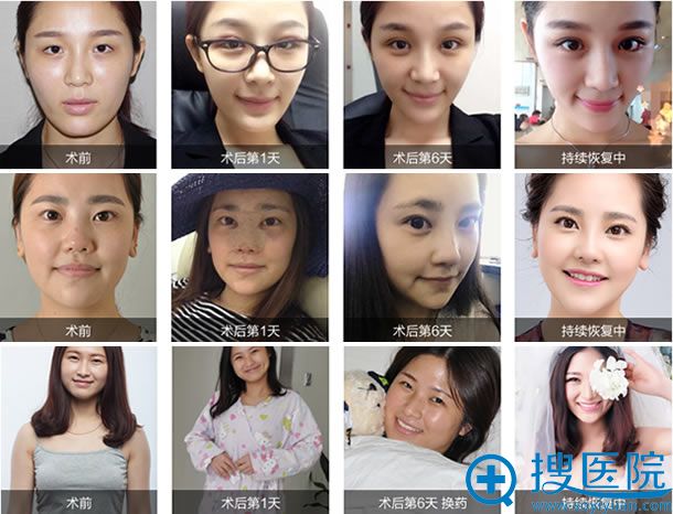 <!--<i data=20240710 data-id=14448></i>-->整形医院手术案例 <!--<i data=20240710 data-id=14448></i>-->整形医院手术案例