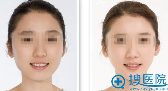 彩光嫩肤祛斑效果 彩光嫩肤祛斑效果