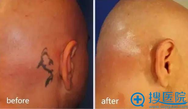 �Ͼ�ʩ�����䳲Ƥ������ϴ����Ч��