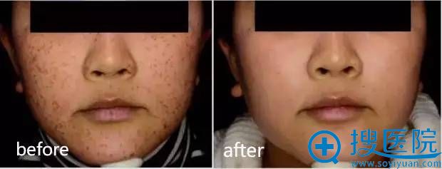 �Ͼ�ʩ�����䳲Ƥ���������Ч��