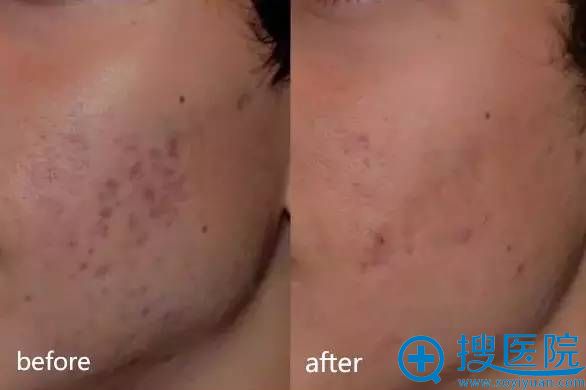 �Ͼ�ʩ�����䳲Ƥ�����������Ч��