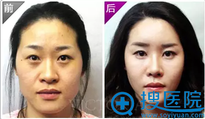 开运整形之丰太阳穴和卧蚕的前后效果 开运整形之丰太阳穴和卧蚕的前后效果