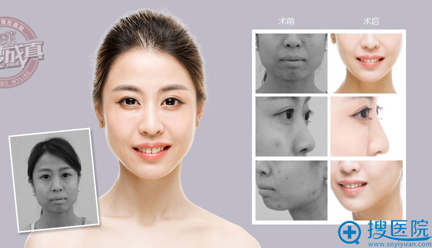 宁波美莱真人案例 宁波美莱真人案例
