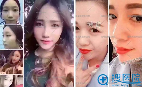 福州格莱美玻尿酸整形案例 福州格莱美玻尿酸整形案例