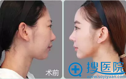 开运整形之自体脂肪丰额头案例 开运整形之自体脂肪丰额头案例