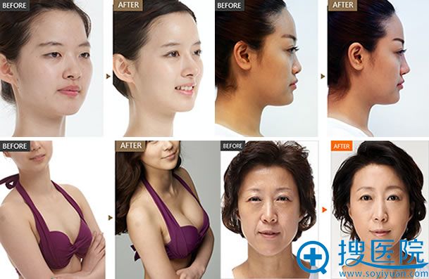 杭州艺星整形案例效果图 杭州艺星整形案例效果图