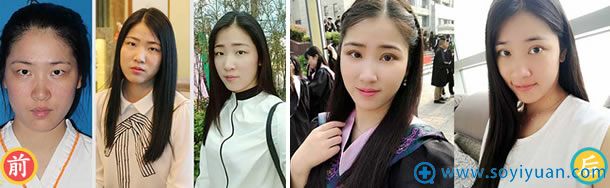 杭州艺星为小雅做美眼前后对比照 杭州艺星为小雅做美眼前后对比照