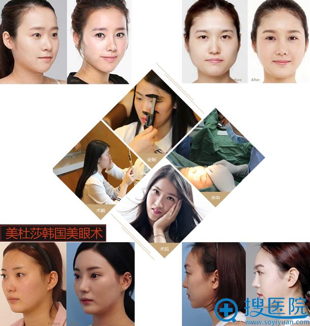杭州艺星美杜莎韩国美眼术过程及案例 杭州艺星美杜莎韩国美眼术过程及案例