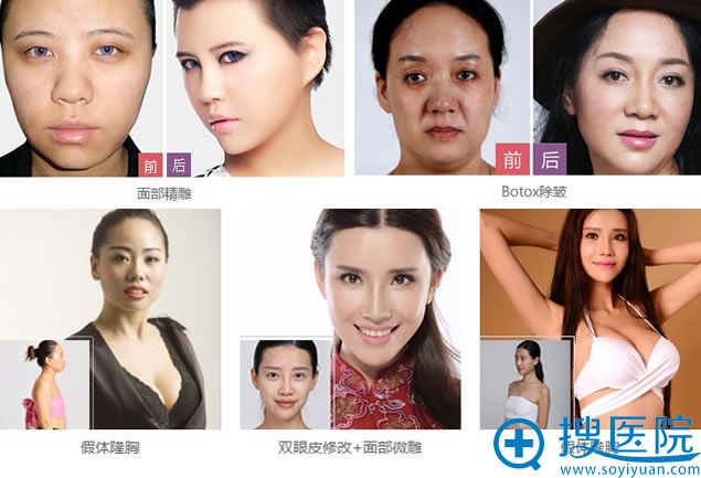 烟台鹏爱整形案例效果 烟台鹏爱整形案例效果