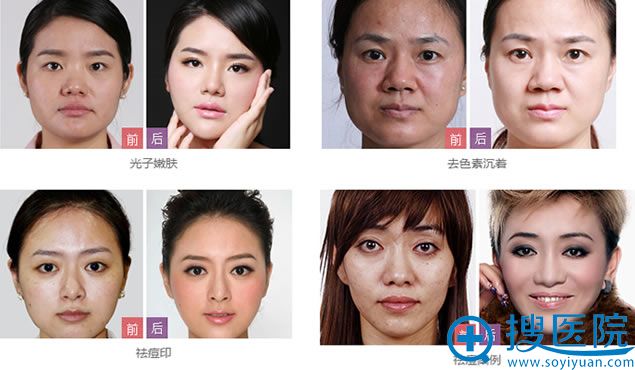烟台鹏爱整形皮肤美容案例 烟台鹏爱整形皮肤美容案例