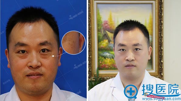 北京华韩整形赛诺秀皮秒激光效果 北京华韩整形赛诺秀皮秒激光效果