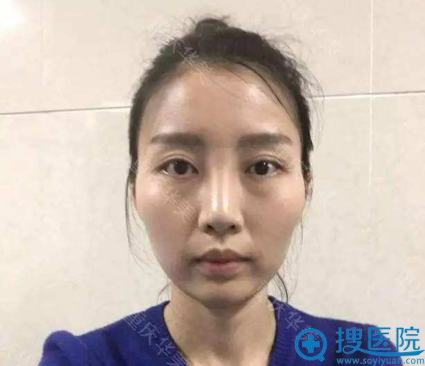 重庆华美美容医院磨骨日记 潘宝华下颌角整形让我30天找回自信