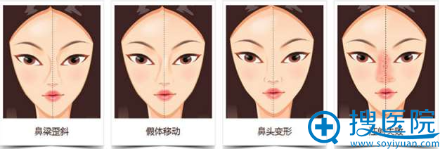 较为典型的集中隆鼻失败情况 较为典型的集中隆鼻失败情况