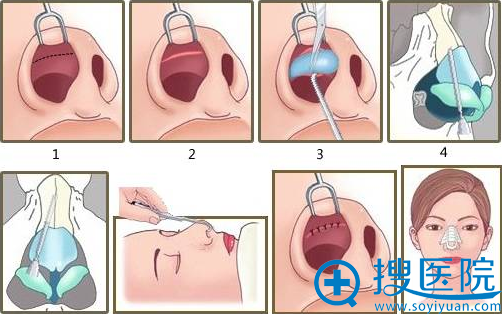 隆鼻失败修复手术流程 隆鼻失败修复手术流程