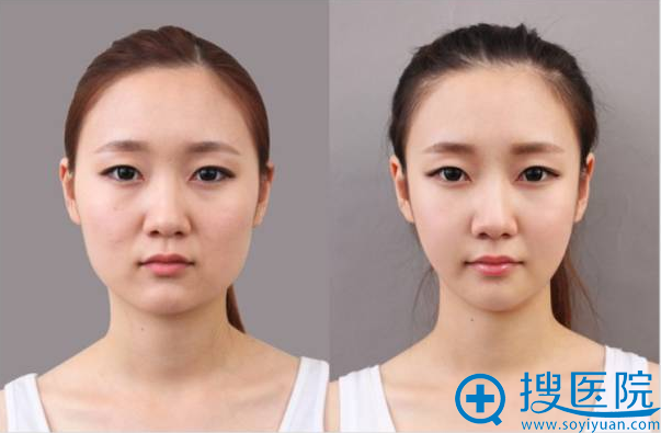 瘦脸除皱案例 瘦脸除皱案例