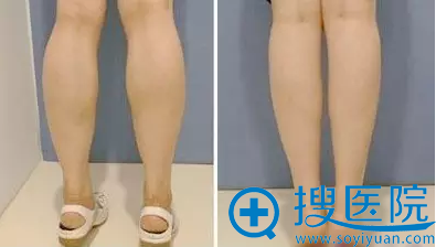 国产衡力瘦小腿案例 国产衡力瘦小腿案例