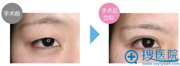 此案例为手术前和手术刚结束时拍的照片。肉眼看上去的肿胀是微小的 此案例为手术前和手术刚结束时拍的照片。肉眼看上去的肿胀是微小的
