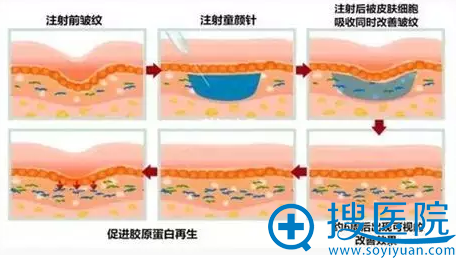 注射童颜针后皮肤发生的变化 注射童颜针后皮肤发生的变化