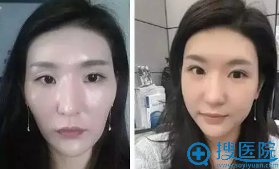<!--<i data=20240710 data-id=11936></i>-->童颜针面部注射案例 <!--<i data=20240710 data-id=11936></i>-->童颜针面部注射案例