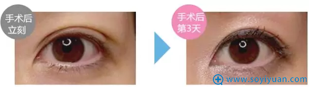上述照片是手术刚结束拍的照片和手术第三天拍的照片 上述照片是手术刚结束拍的照片和手术第三天拍的照片