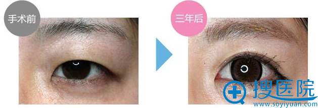 此案例做了微创双眼皮埋线+开内眼角。术后3年双眼皮线条依然非常漂亮 此案例做了微创双眼皮埋线+开内眼角。术后3年双眼皮线条依然非常漂亮
