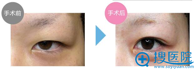 日本圣心肿眼泡做埋线双眼皮案例效果 日本圣心肿眼泡做埋线双眼皮案例效果