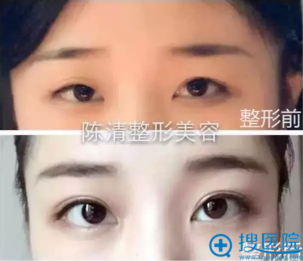 泸州陈清整形陈清院长的陈氏“睛彩”双眼皮形成术