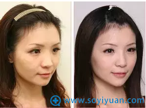 曾繁闻面部玻尿酸注射案例效果图 曾繁闻面部玻尿酸注射案例效果图