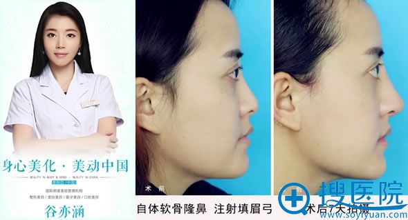 <!--<i data=20240710 data-id=14095></i>-->谷亦涵医生的隆鼻案例 <!--<i data=20240710 data-id=14095></i>-->谷亦涵医生的隆鼻案例