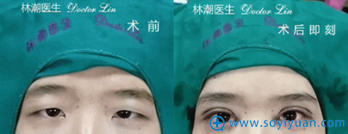 林潮医生第四位切开重睑+上睑去脂+开内眼角真人案例 林潮医生第四位切开重睑+上睑去脂+开内眼角真人案例