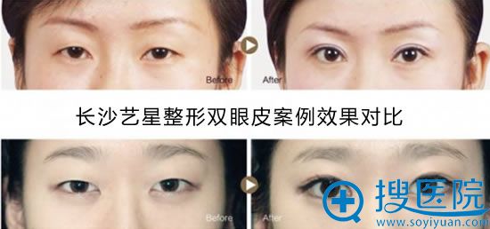 长沙艺星整形双眼皮案例图 长沙艺星整形双眼皮案例图