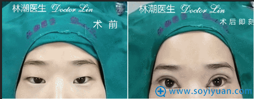 林潮医生第二位三点微创法+开内眼角真人案例 林潮医生第二位三点微创法+开内眼角真人案例