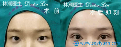 林潮医生切开重睑+开内眼角真人案例 林潮医生切开重睑+开内眼角真人案例