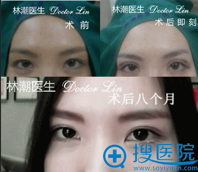 林潮医生三点微创重睑+上睑去脂真人案例 林潮医生三点微创重睑+上睑去脂真人案例